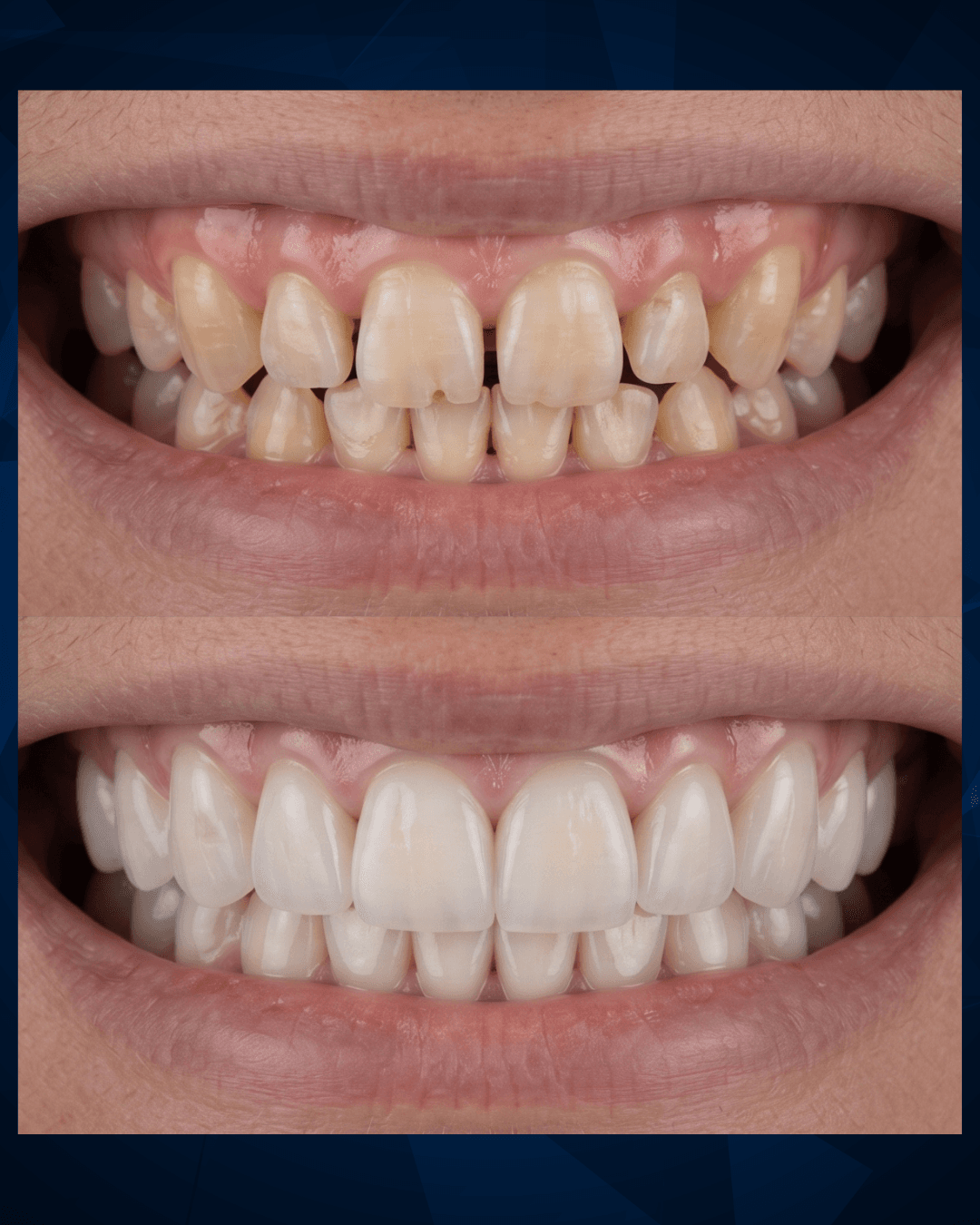 Lentes de contato dental — sorriso natural